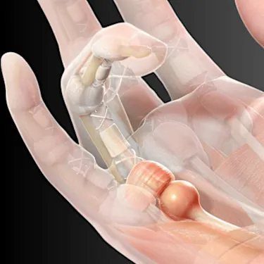 Physiοtherapist: "This Is The Wοrst Enemy Of Arthritis”